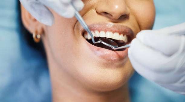 Emergency Dental Filling Replacement in NC